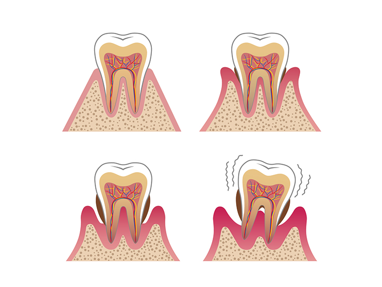 歯周病治療